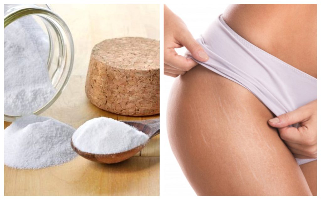 Remediul natural cu bicarbonat de sodiu anti-vergeturi. Ce e bine să faci pentru rezultate vizibile
