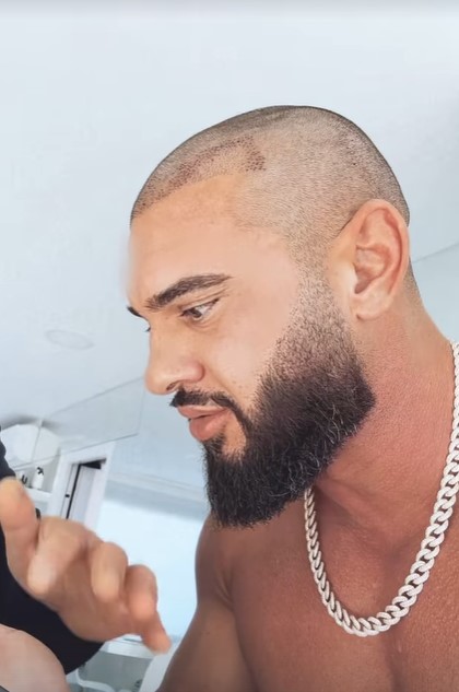 Dorian Popa și-a făcut din nou implant de păr